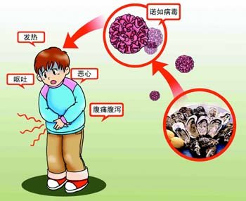 诺如病毒急性胃肠炎